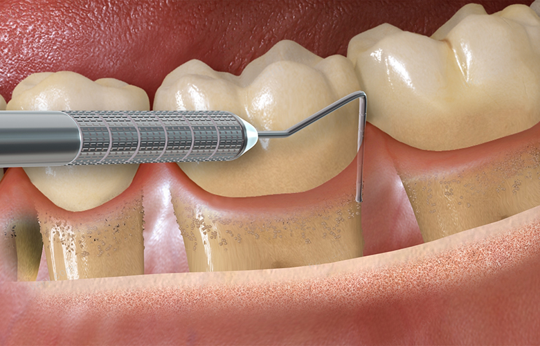 Periodoncia